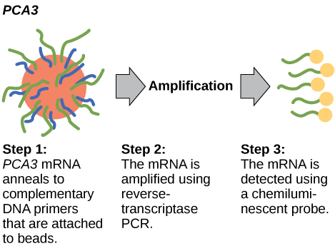 The PCA3 test occurs in three steps. In step one, PCA3 mRNA anneals to complementary DNA primers that are attached to beads. In step two, the mRNA is amplified using reverse-transcriptase PCR. In step three, the mRNA is detected using a chemiluminescent probe.