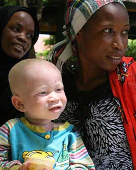 Photo shows an albino child with his black mother.