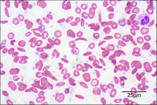 Sickle cell disease: Sickle cells are crescent shaped, while normal cells are disc-shaped.