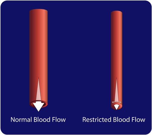 Constricted blood vessels