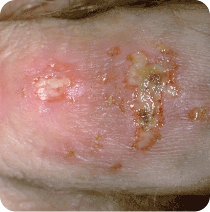 Genital Herpes blister