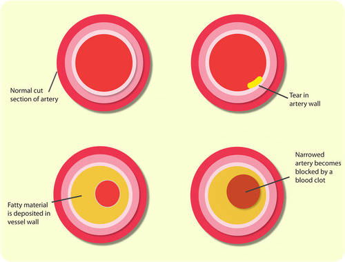 Cross section of plaque development
