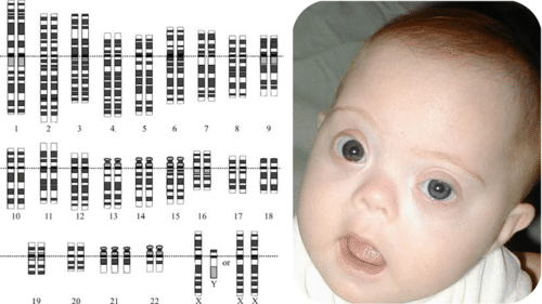 Karyotype and Down Syndrome