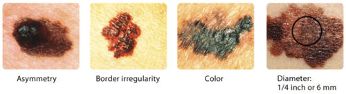 Signs of skin cancer